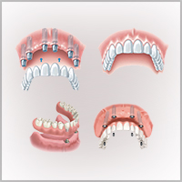 جراحی کاشت دندان ( ایمپلنت )